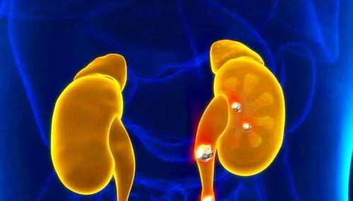 肾结石吃咸瓜,肾结石患者需谨慎