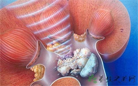 肾结石吃咸瓜,肾结石患者需谨慎