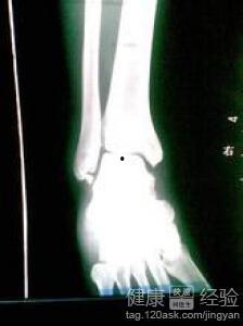 骨折手术后可以吃瓜,骨折手术后饮食指南